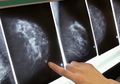 Dapat Donor Organ dari Orang yang Sama, 4 Pasien Ini Terkena Kanker Payudara bahkan Ada yang Sampai Meninggal
