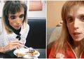 Berat Gadis Anoreksia Usia 26 Tahun Ini Hanya 17 Kg, Ternyata Ini yang Dikonsumsinya!