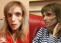 Derita Anoreksia, Perempuan Ini Malah Dapat Komentar Pedas dari Dokter