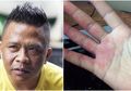 Oon Project Pop Meninggal Karena Diabetes 6 Tahun, Telapak Tangan dan Kaki Jadi Tandanya, Cek Sekarang!