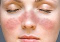 Penting dan Mudah Dilakukan, Ini 4 Tips Cegah Penyakit Lupus