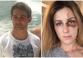 Anak Konglomerat Brasil Pukuli Pacarnya Hingga Cedera Parah Hanya Karena Unggahan Foto di Instagram
