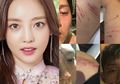 Choi Jung Bum Rilis Foto Cakaran Goo Hara Usai Dilaporkan karena Kekerasan dan Skandal Video