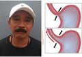 Hoaks Opie Kumis Sakit Lambung Kronis: Mengenal Kategori Sakit Lambung dan 7 Makanan yang Membantu Mengurangi Gejalanya