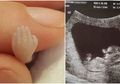 Keguguran Saat Janinnya Berusia 14 Minggu, Perempuan Ini Tunjukkan Bentuk Tangan & Kaki Bayinya