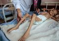 Perang Arab Saudi dan Iran Merenggut Nyawa Gadis Cilik Asal Yaman