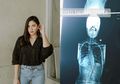 Jessica Mila Menderita Skoliosis, Ternyata 4 Hal Inilah yang Bisa Jadi Penyebabnya!