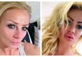 Ingin Miliki Bibir Seksi dengan Lakukan Filler, Ini Hasil yang Didapat Perempuan Ini