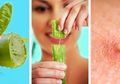 7 Cara ini Manjur Buat Atasi Jerawat yang Ada di Telinga, Salah Satunya dengan Gel Lidah Buaya