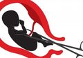 Gara-gara Para Ibu Takut Diusir Suami Jika Hamil Anak Perempuan, Pakistan Jadi Negara dengan Jumlah Aborsi Tertinggi di Dunia