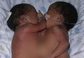Bayi Kembar Siam Ini Lahir dengan Hati dan Dada Menyatu, 16 Tahun Kemudian Mereka Tumbuh Jadi Gadis Cantik!