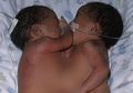 Lahir dengan Satu Hati, Bayi Kembar Siam Ini Hidup Sehat dan Normal