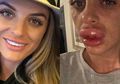 Suntik Filler di Sebuah Pesta, Bibir Perempuan Ini Bengkak 5 Kali Ukuran Normal!