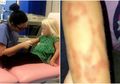 Seorang Anak Berteriak Kesakitan dan Gatal karena Tato Henna, Bekas Lukanya Berbentuk Kucing yang Membuat 'Cacat Permanen'