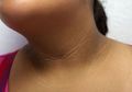 Muncul Kerak Hitam pada Leher, Ketiak atau Siku, Berbahayakah?
