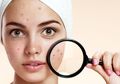 Yuk Hilangkan Jerawat Bruntusan dengan 7 Bahan Alami Berikut Ini!
