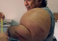 Kecelakaan Saat Mencari Kerang, Bentuk Tubuh Pria Ini Berubah Seperti Popeye! Ini Penyebabnya