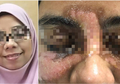 Ingin Cantik Sempurna, Kulit Perempuan Ini Justru Cacat Permanen Usai Perawatan Spa