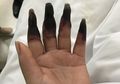 Jari-jarinya Berubah Menjadi Hitam Lebam Laiknya Membusuk, Penyakit Apa Ini?