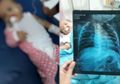 Jangan Sepelekan Batuk pada Bayi, Bisa Jadi Itu Gejala Pneumonia, Pembunuh Bayi Nomor Satu di Indonesia