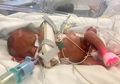 Lahir dengan Berat Kurang Dari 1 Kilogram dan Diprediksi Alami Kerusakan Otak, Bayi Ini Tumbuh Mengagumkan!