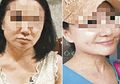Hidup Nelangsa dan Gagal Menikah karena Berwajah 'Jelek,' Wanita Ini Lakukan Operasi Plastik dan Mengubah Nasibnya