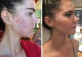 Gadis Kembar Ini Hilangkan Jerawat di Seluruh Wajah dengan Diet Sederhana! Ini Resepnya