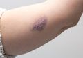 Ini 5 Gejala Leukemia yang Sering Kali Diabaikan, Salah Satunya Memar di Tubuh