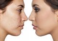 Bahayakah Menggunakan Makeup Saat Kulit Wajah Berjerawat?
