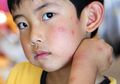 Berkenalan dengan Penyakit 'Darah Manis' yang Bikin Kulit Anak Mudah Bentol dan Luka