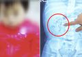Kelainan Ginjal Anak Bisa Dideteksi dan Ditangani Sejak di Kandungan
