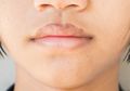 5 Cara Gampang Menghilangkan Titik Hitam di Bibir Akibat Sinar Matahari