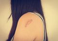 Hilangkan Keloid dengan 6 Bahan Alami Ini, Tanpa Operasi dan Rasa Sakit!