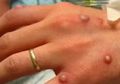 Monkeypox, Virus Mematikan Baru yang Mirip Cacar, Belum Ada Vaksin Khusus untuk Menanganinya