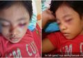 Mata Bocah Asal Bojonegoro Ini Mendadak Lebam dan Keluar Darah Akibat Kecanduan Main HP