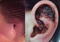 Disangka Kutil Selama 5 Tahun, Wanita Ini Harus Rela Telinganya Diamputasi, Ternyata Ini Penyebab Sebenarnya