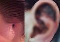 Telinganya Mengoreng Hingga Diamputasi, Ternyata Wanita Ini Terkena Penyakit Mengerikan