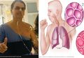 Presiden Brazil Menderita Pneumonia, Waspadai 7 Gejalanya dari Batuk hingga Pusing yang Jarang Disadari