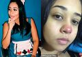 Tragis, Lakukan Tindik Hidung, Wanita Ini Berakhir Dengan Kelumpuhan