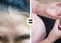 6 Tanda Kenali Penyakit Lewat Keringat, Termasuk Karena Kurang Gula Darah atau Obesitas
