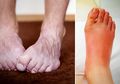Ini 10 Gejala Kaki yang Ungkapkan Masalah Kesehatan Kita, Waspadalah!