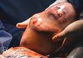 Dilahirkan Melalui Operasi Caesar, 'Bayi Gelembung' Ini Membuat Orang di Sekitarnya Takjub, Berbahayakah Kondisi Ini?