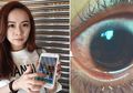 Sering Menatap Layar Ponsel dengan Kecerahan Maksimal, Mata Wanita Ini Berakhir dalam Kondisi Mengerikan