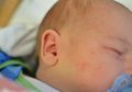 Jangan Terlalu Khawatir, Ini Tips Mencegah dan Mengobati Biduran pada Bayi