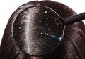 Bebas Kepala Gatal dan Rambut Rontok Gara-Gara Ketombe, Hanya #5MenitAja Pakai Masker Baking Soda Ini