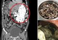 Pasiennya Cuma Mengeluh Sakit Perut, Tim Dokter Kaget Saat Temukan 2 Kg Batu hingga Sampah Memenuhi Lambung Pasien