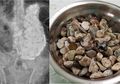 Seorang Pria Mengeluh Sakit Perut, Dokter Terkejut Temukan 2 Kg Batu, Koin, dan Tutup Botol dalam Perut Pria Tersebut