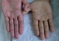 Jangan Abaikan, Ini 6 Tanda Anemia dan Perawatan Alaminya!