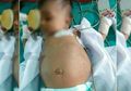 Dikira Tumor, Perut Bayi 3 Bulan Ini Berisi Janin Tumbuh, Kok Bisa?