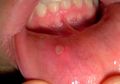 10 Cara Alami Menyembuhkan Sariawan dengan Cepat